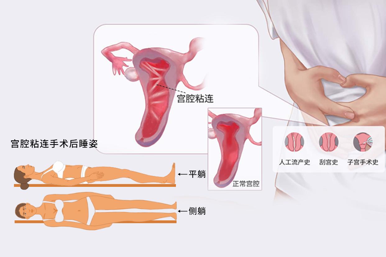 宫腔粘连手术后睡姿正确图片 宫腔粘连手术后睡姿正确图片