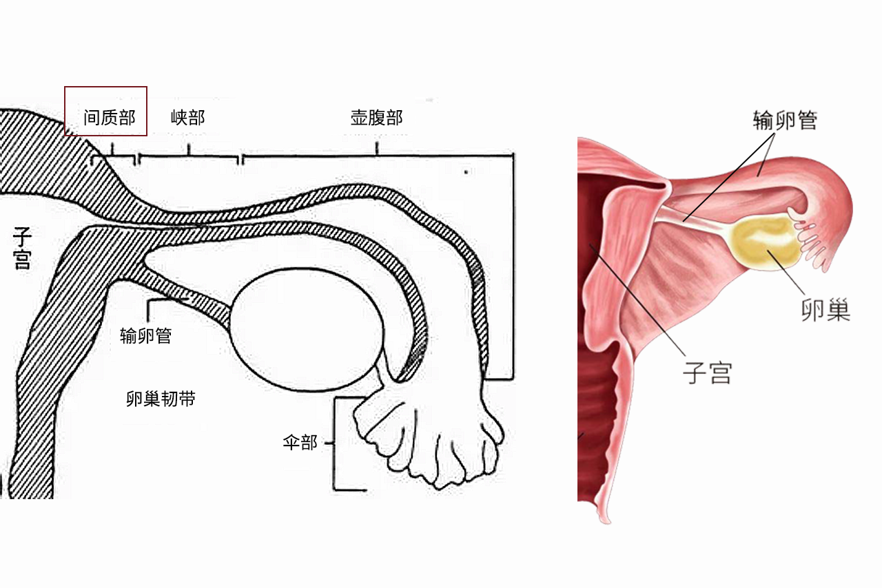 输卵管间质部图片 输卵管间质部的临床意义