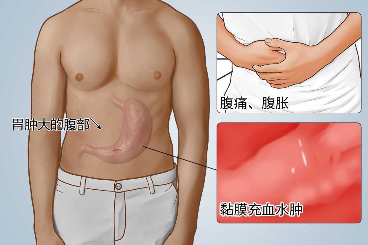 胃肿大的腹部图片（胃肿大严重吗）