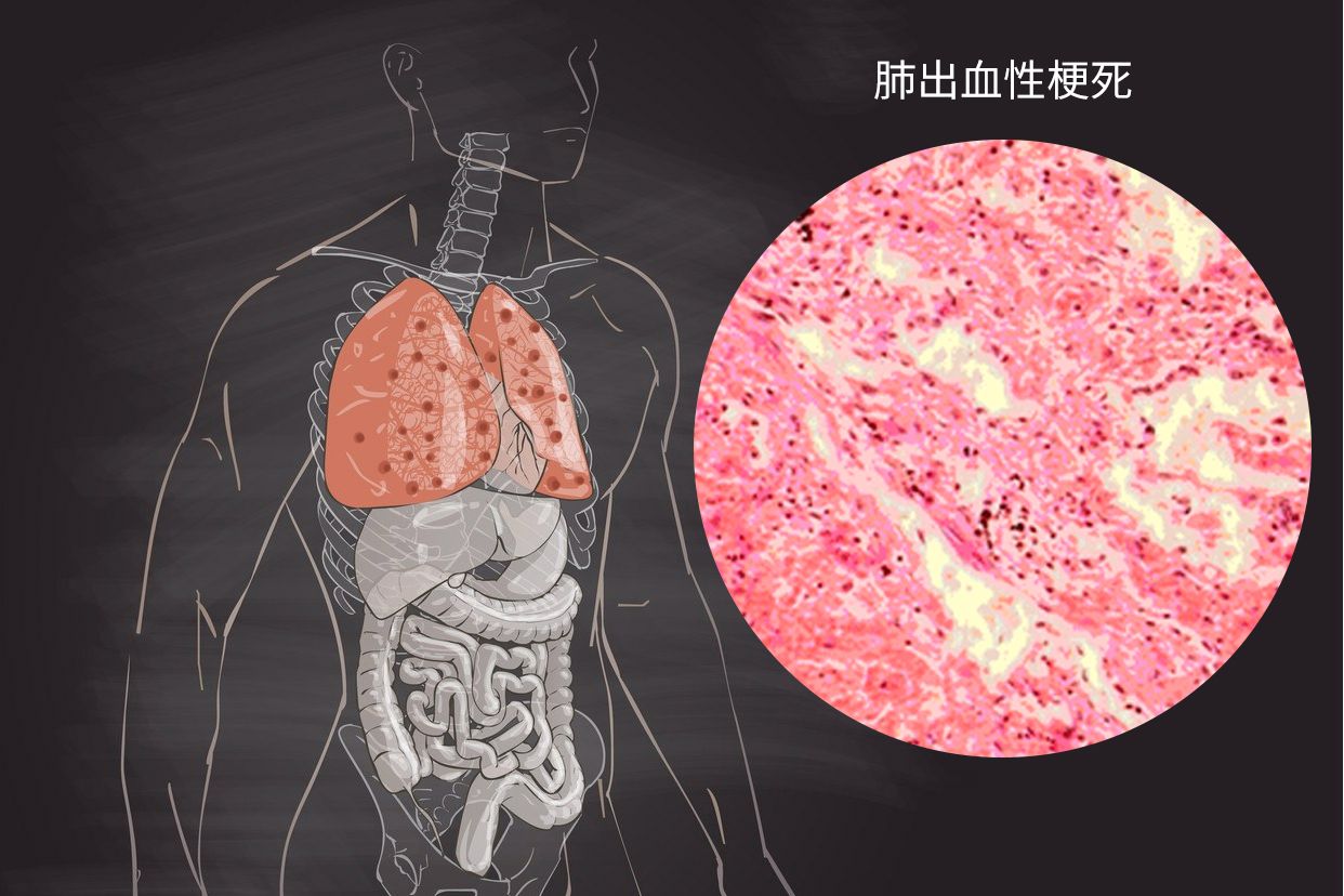 肺出血性梗死图片手绘图（肺出血性梗死图片大全）