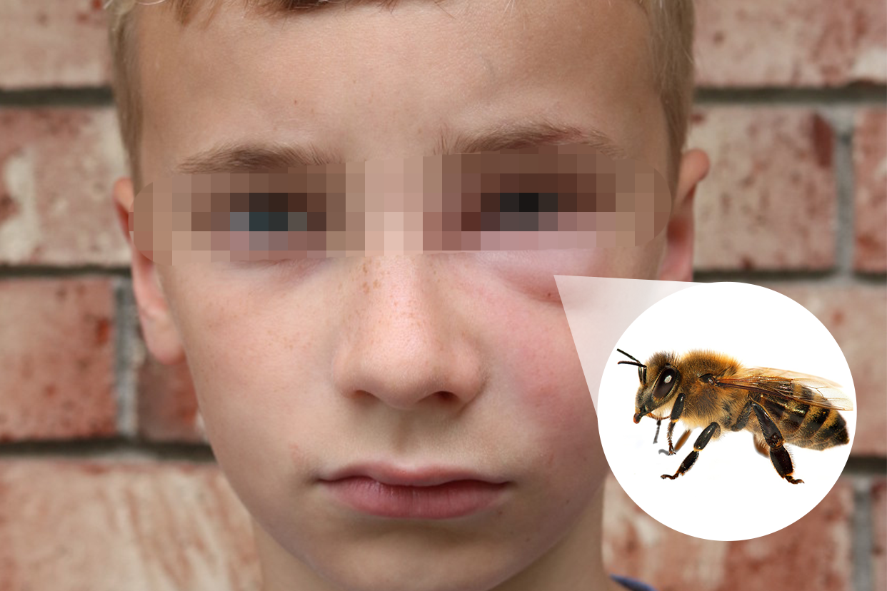 小孩被蜜蜂蛰了肿图片 小孩被蜜蜂蛰了红肿几天消除
