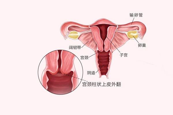 宫颈口外翻是怎么回事图片 宫颈口外翻是怎么回事图片女