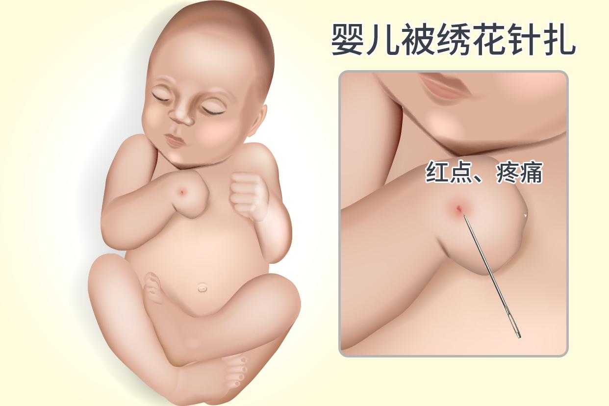婴儿被绣花针扎了怎么办图片 宝宝被绣花针进身体怎么发现