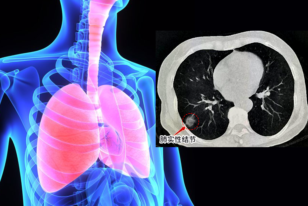 肺实性结节图片 肺实性结节图片大全