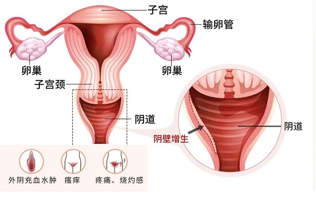 阴壁增生症状图片 阴壁增生是什么