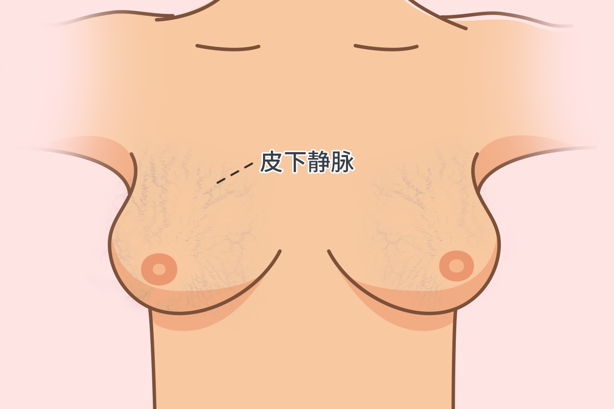 乳房皮下静脉图片（乳房皮下浅静脉血栓）