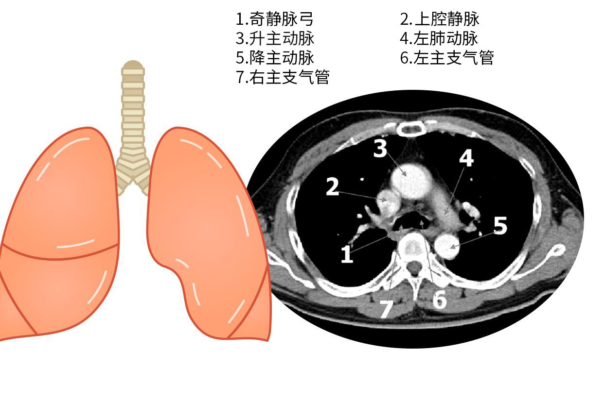 主动脉肺动脉窗图片（主动脉肺动脉窗ct图片）