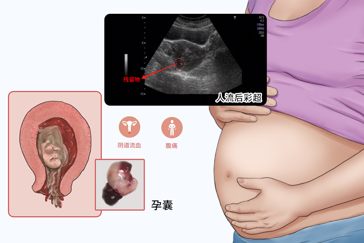 人流后有残留彩超图片 人流术后残留超声图片