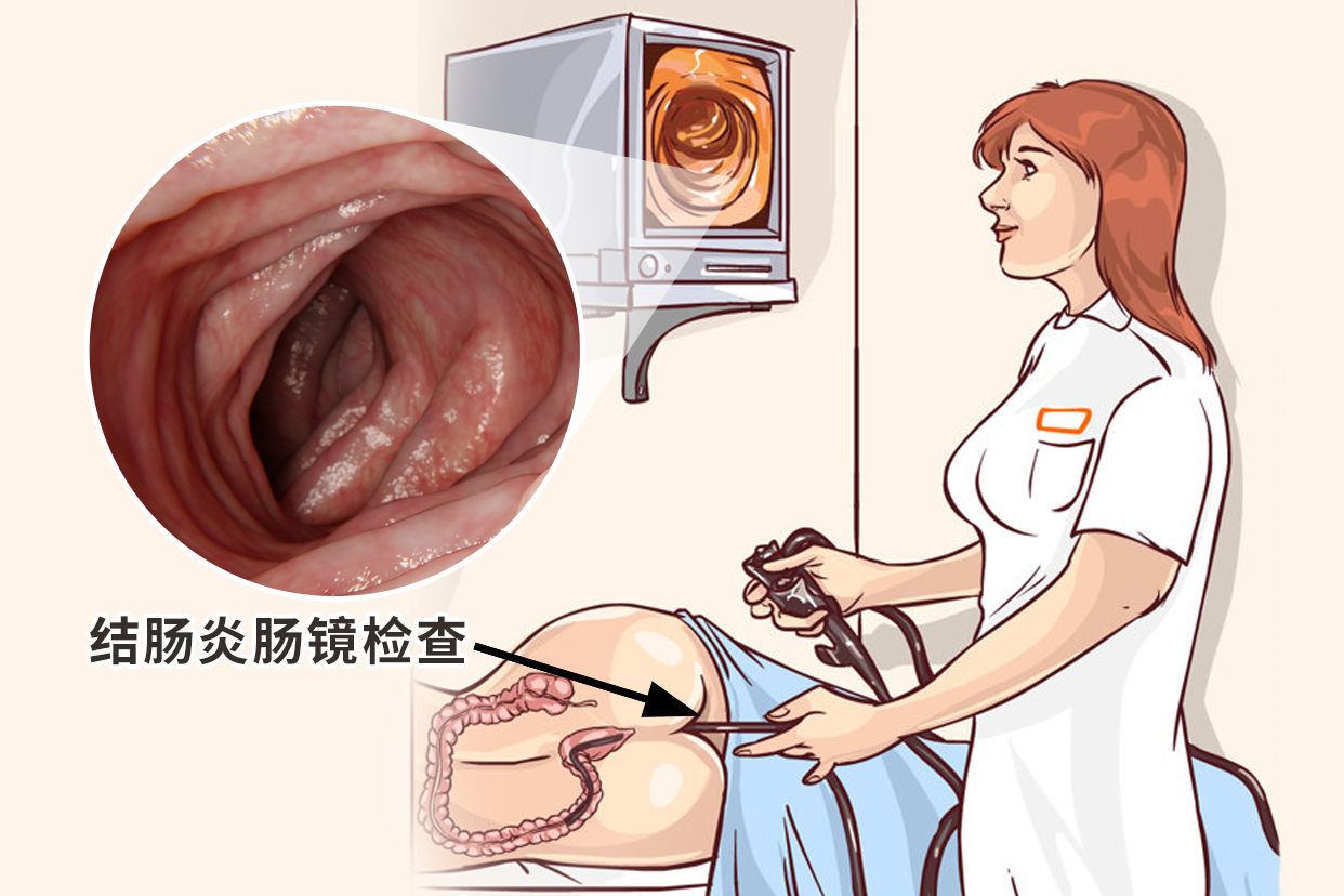 结肠炎肠镜检查图片（结肠炎的肠镜图片）