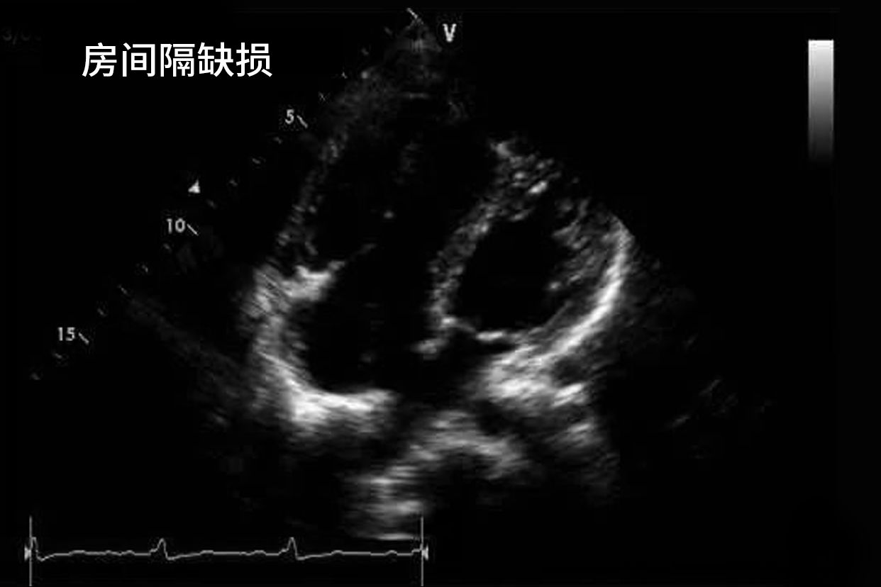 房间隔缺损超声心动图的特征 房间隔缺损超声心动图的特征是