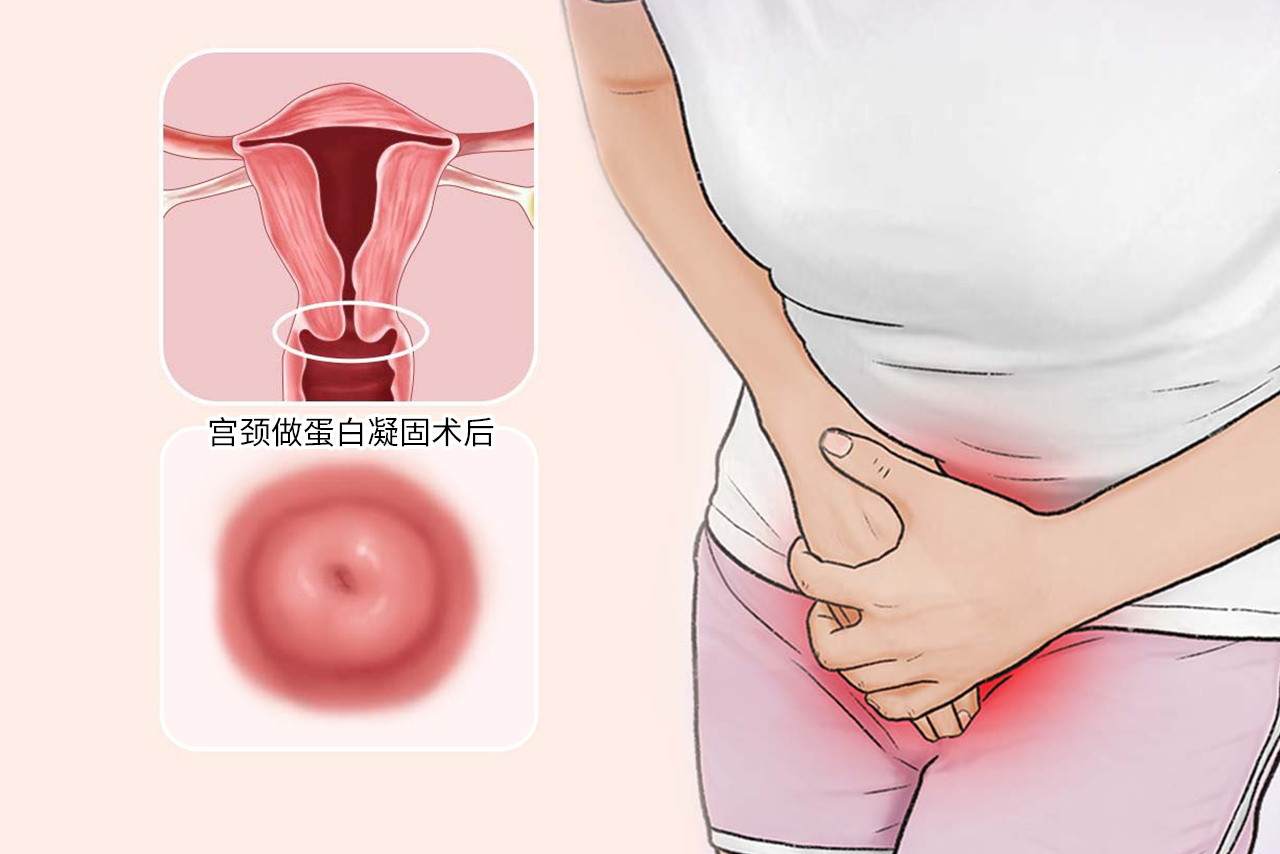 宫颈做蛋白凝固术后图片 宫颈蛋白凝固术后多久痊愈