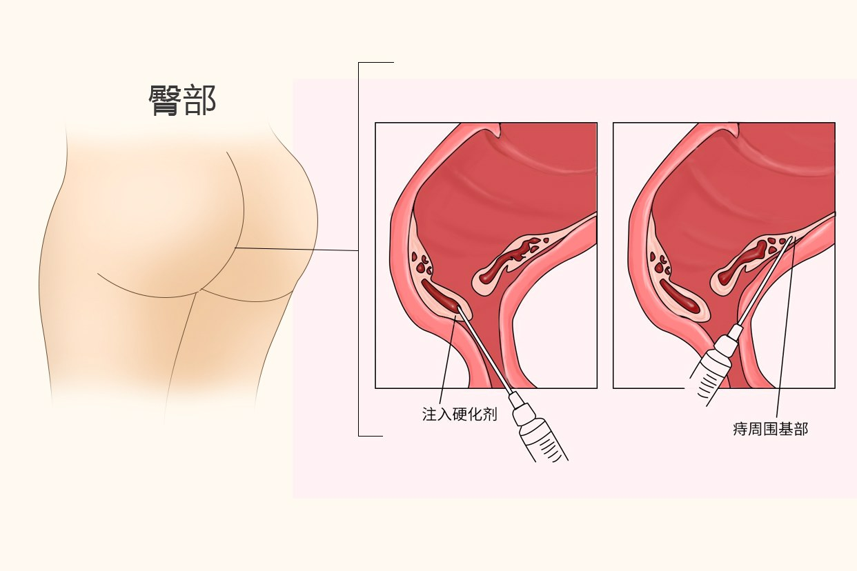 痔疮打针后一个星期后图片（痔疮打针后几天很痒怎么回事）