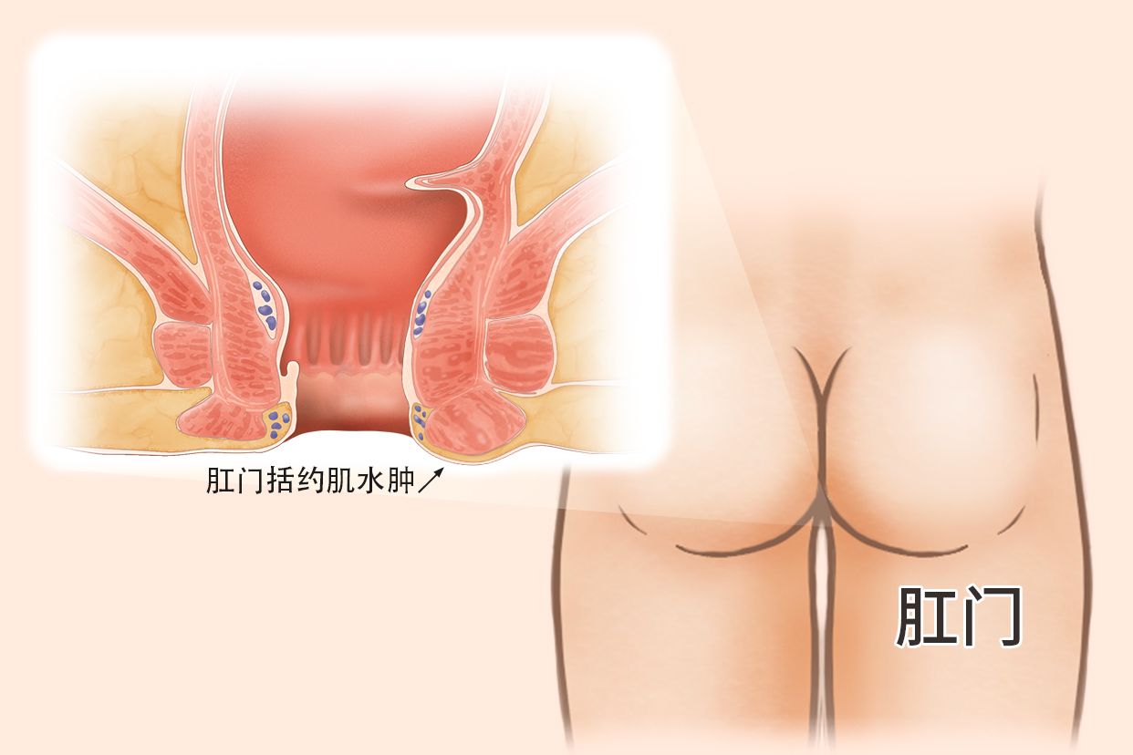 肛门括约肌水肿图片（肛门括约肌肿大怎样消肿）