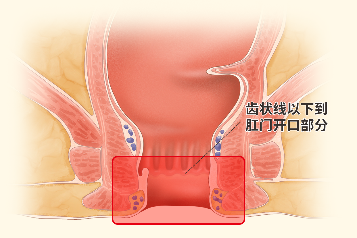 肛管癌位置图片（肛管癌症状图片）