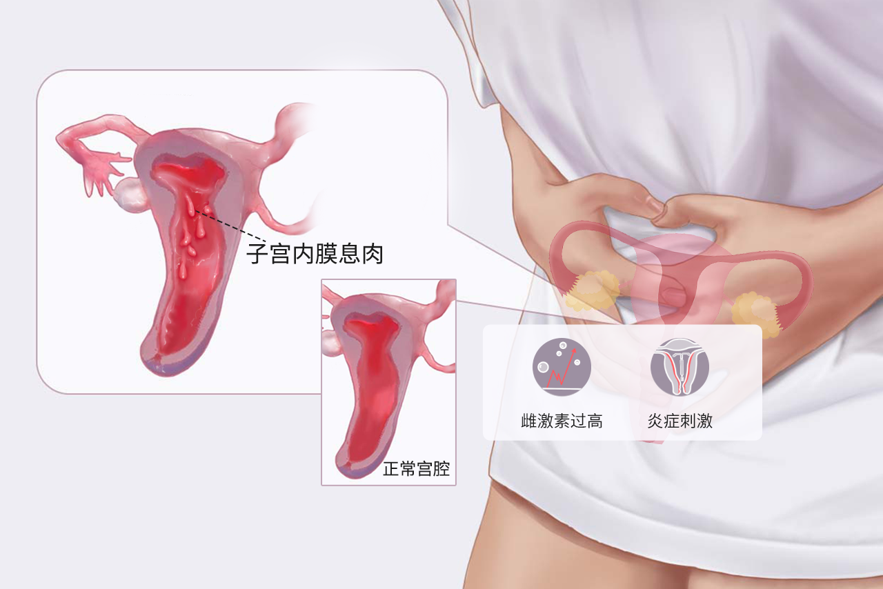 子宫内膜息肉长什么样 子宫内膜多发息肉严重吗