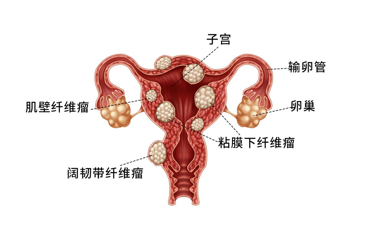 阴壁内肿瘤的图片