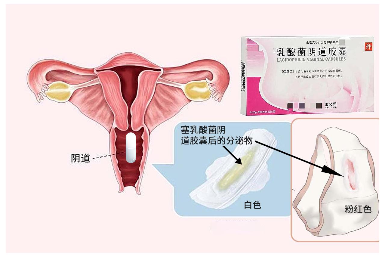 塞乳酸菌后的分泌物图片 塞乳酸菌后的分泌物图片真实