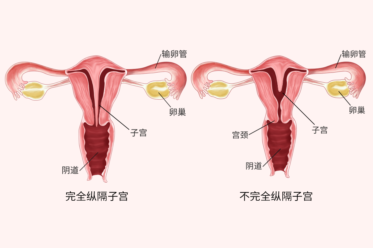 重隔子宫图片 纵隔子宫是怎么回事