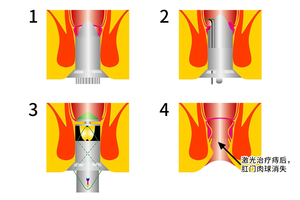 痔疮激光术后肛门口肉球图（痔疮激光后肛门肿是什么样的）