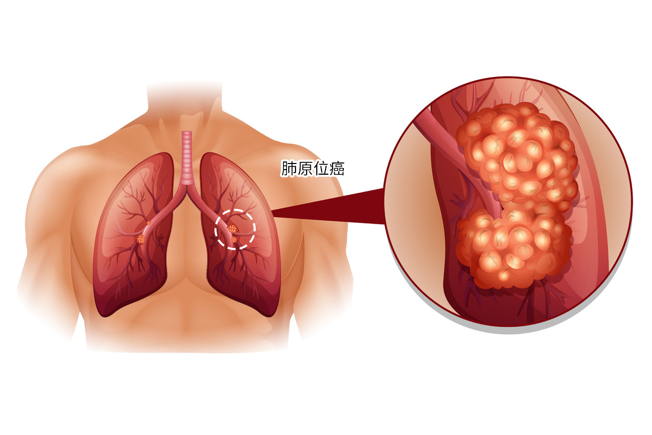 肺原位癌图 肺原位癌一般能活多久