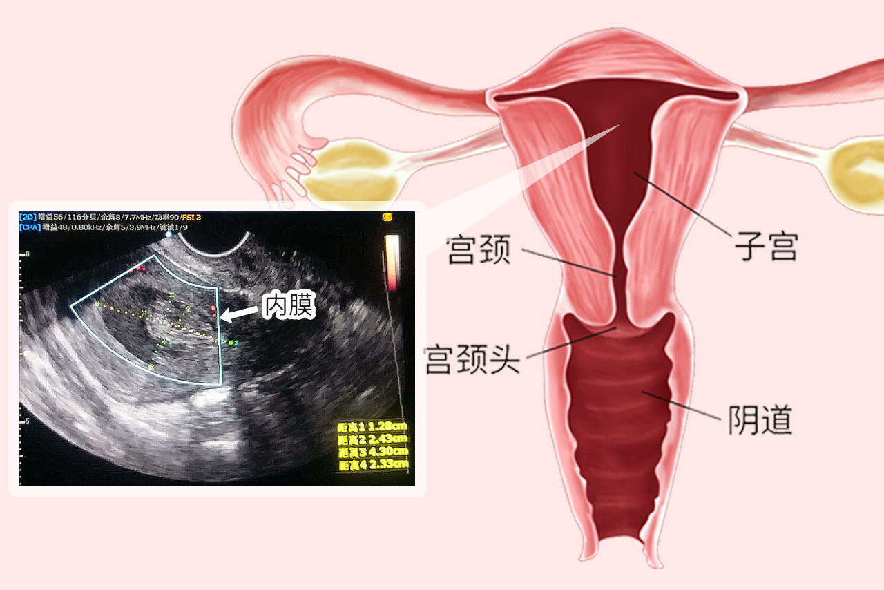 子宫内膜彩超图解 子宫内膜彩超图解