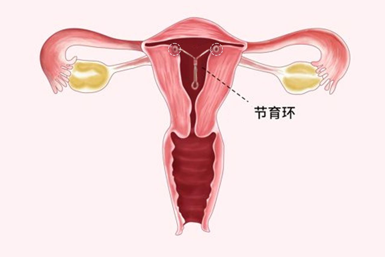 带环长肉上的图片（带环长肉里面了怎么办）