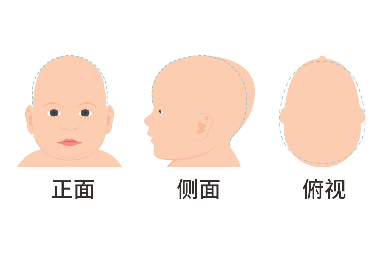 婴儿头两侧有凹陷怎么回事图片（婴儿头部两侧凹陷怎么回事）