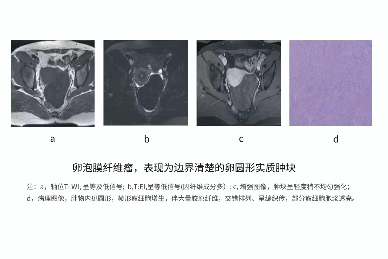 纤维卵泡膜细胞瘤图片（纤维卵泡膜细胞瘤症状）