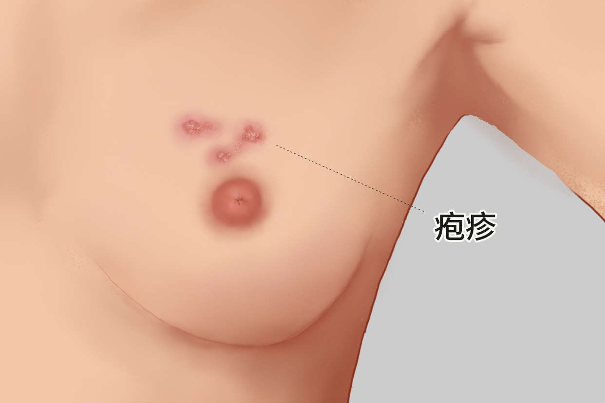女性乳房长疱疹图样 女性乳房疱疹是什么引起的