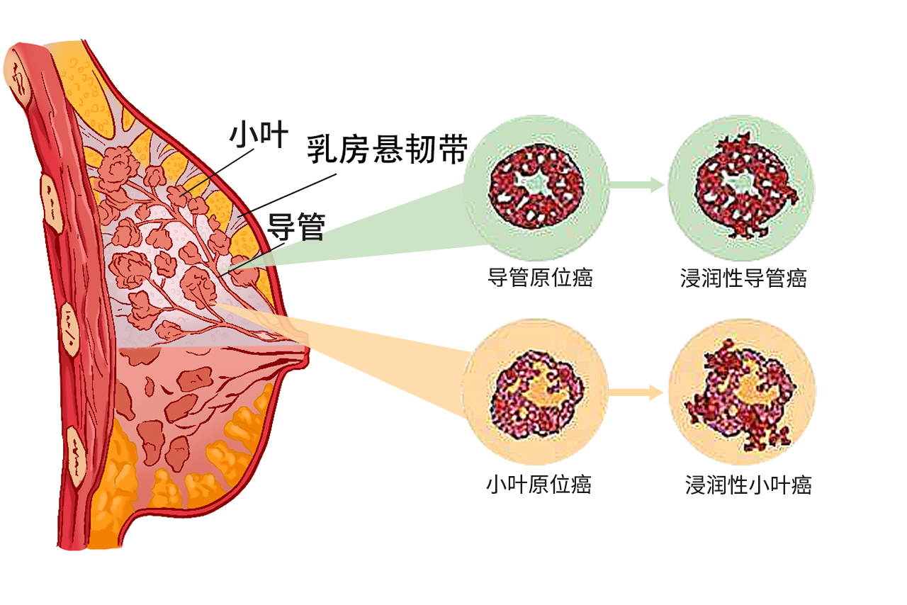 浸润性乳腺癌的图片和症状有哪些