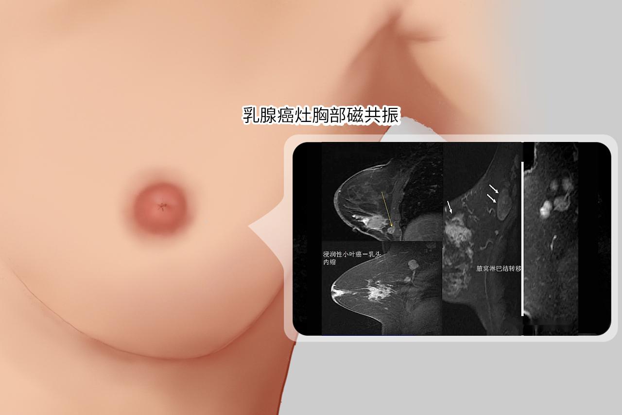 乳腺癌灶胸部磁共振图片