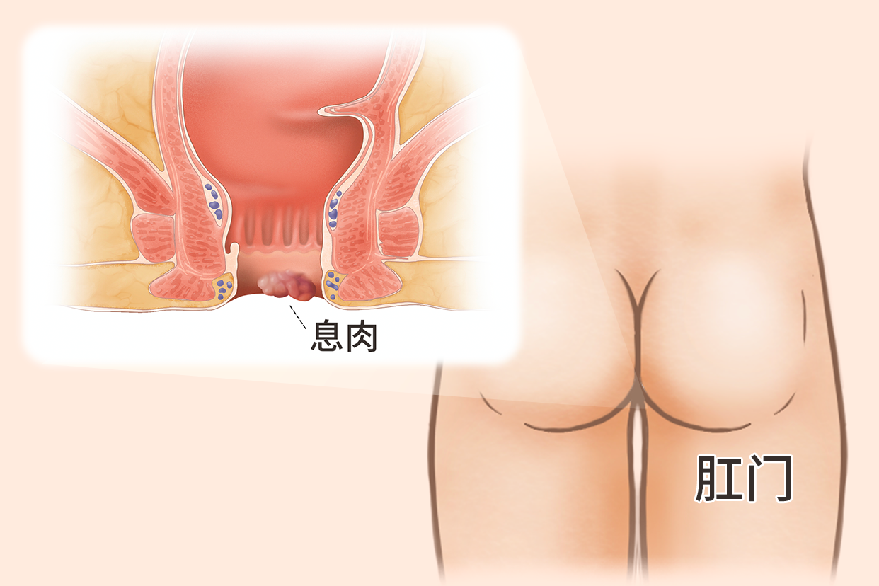 肛门肠息肉图片