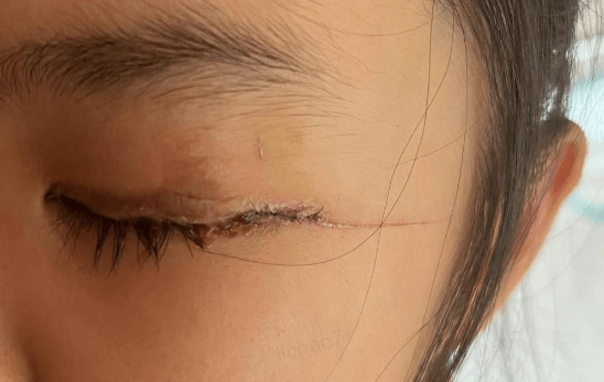 山东5岁女孩在幼儿园眼睑受伤，被发现事发时段监控缺失，教育公安部门已介入