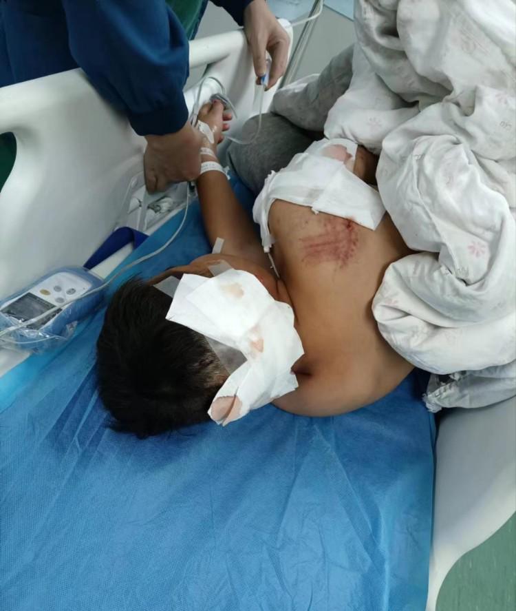 湖南城步10岁男童遭阿拉斯加犬咬伤，事发第三天仍在ICU病房内救治